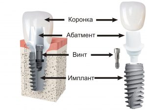 Імплантація зубів